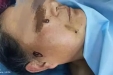 我院神经医学科（头颈外科）完成全州首例三叉神经球囊压迫术