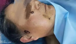 我院神经医学科（头颈外科）完成全州首例三叉神经球囊压迫术