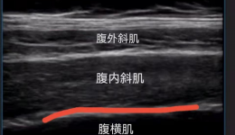 【麻醉新技术】腹部手术后多模式镇痛：腹横肌平面阻滞(TAP阻滞)
